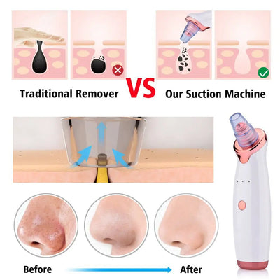 FlawlessPore | Electric Facial Pore Vacuum